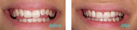 Cosmetic Dentistry Before and after the treatment 3 at Dentist Brentwood
